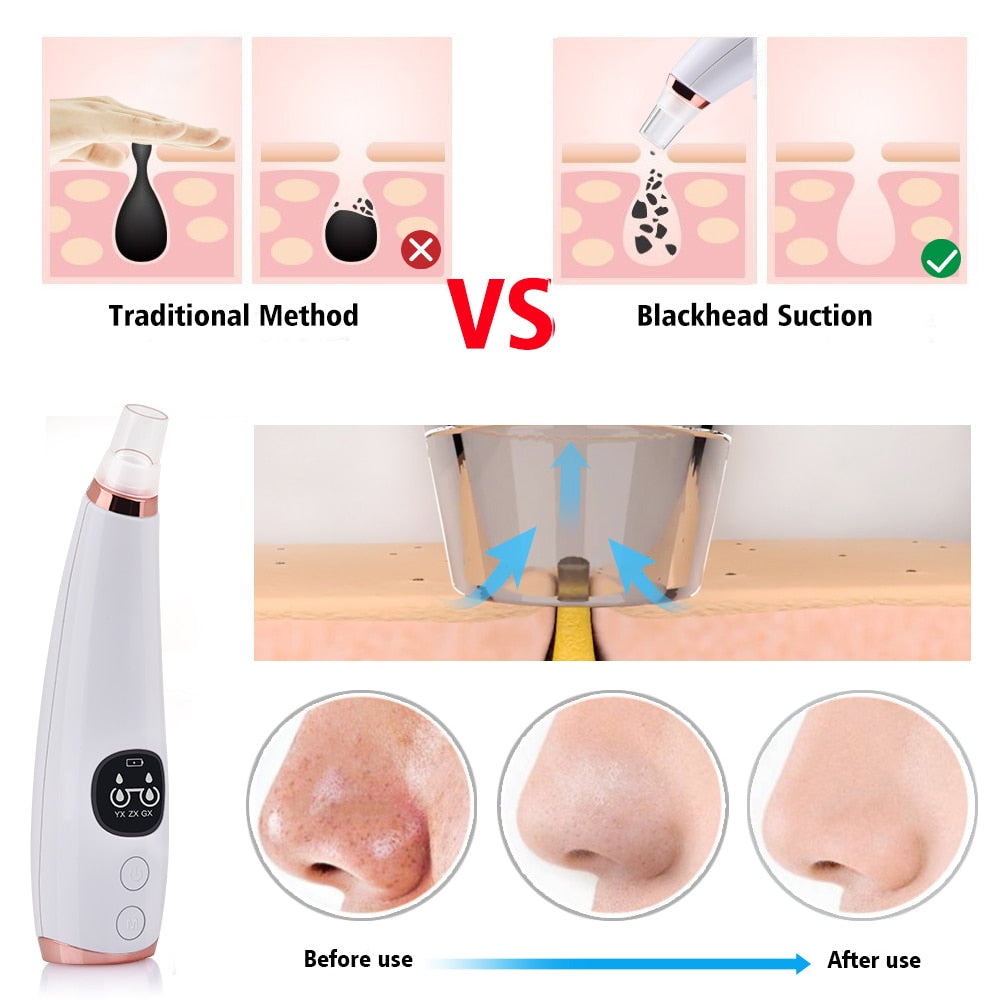 Vacuum Pore Cleaner